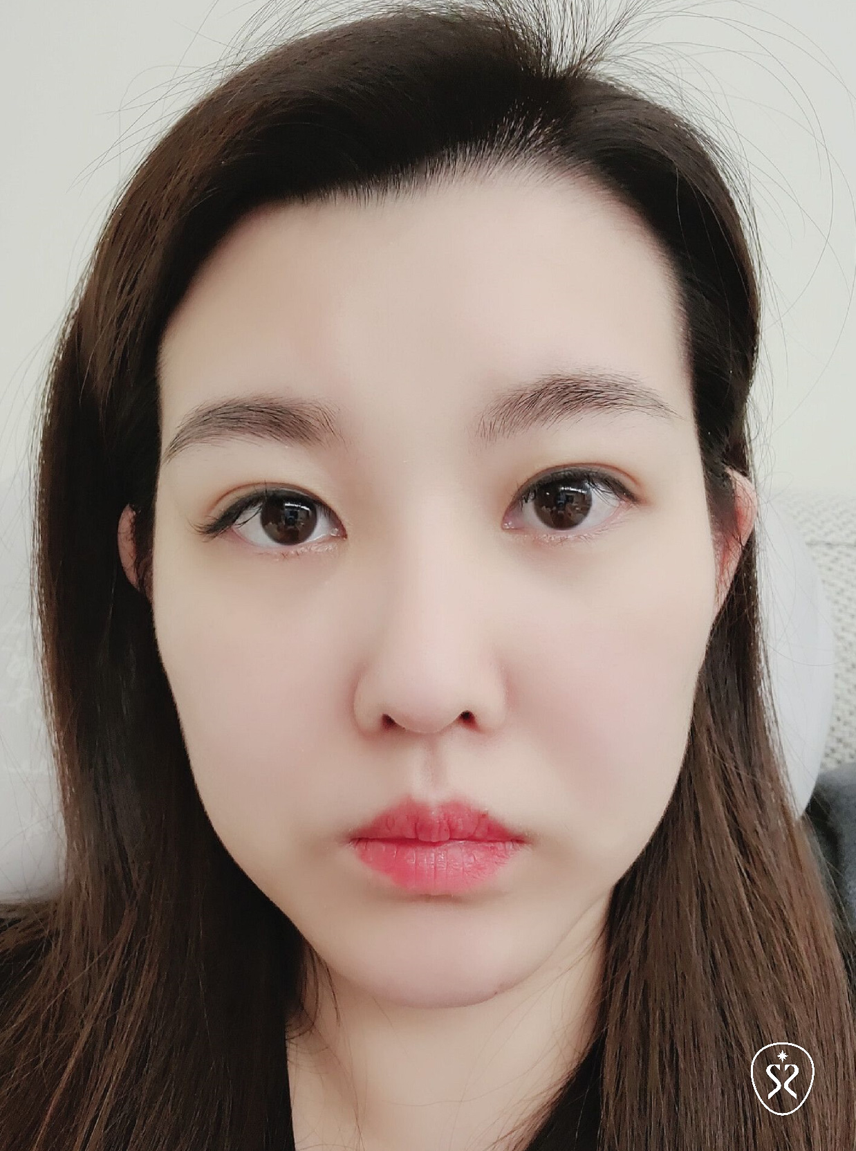 因疫情三年未做醫美導致嘴邊肉明顯下垂